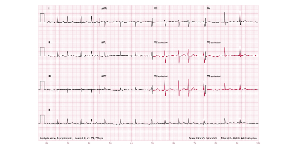 EKG rhythm strip showing the arrhythmia atrial fibrillation