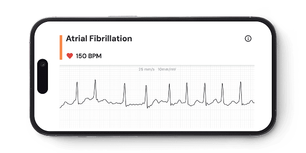 Kardia app with AFib EKG reading on a phone, showing real-time AFib detection